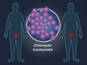 Azithromycin vs. Doxycycline for rectal chlamydia | क्लैमीडियिएसिस