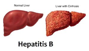 Hepatitis b ke lakshan: क्या है 'हेपेटाइटिस बी' कैसे कर सकते हैं इससे बचावहेपेटाइटिस बी