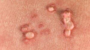 Hpv warts: the misunderstood std | everyday healthजेनिटल मस्सा / मस्सा की बीमारी / genital wort