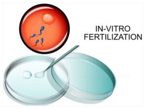 In-vitro fertilization (ivf) - पात्रे निषेचन (in vitro fertilization – ivf)