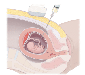 उल्बवेधन (amniocentesis)